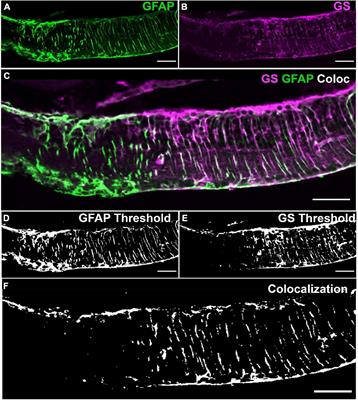 Loss of Müller cell glutamine synthetase immunoreactivity is associated with neuronal changes in late-stage retinal degeneration